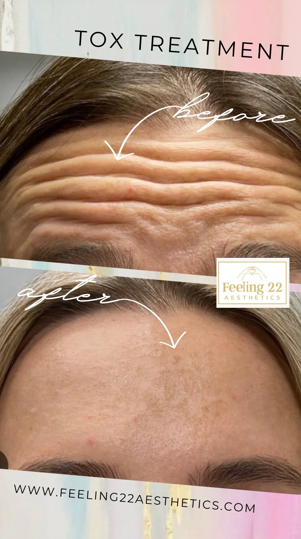 Before and after images of forehead treatment, showing reduction in wrinkles and improved skin smoothness.