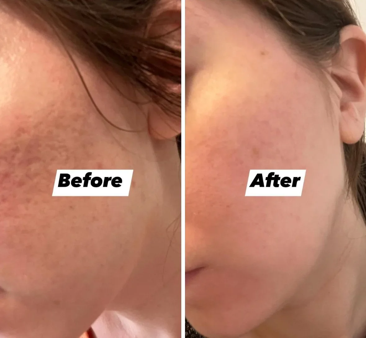 Close-up comparison of skin before and after treatment, showing reduced redness, hyperpigmentation, and clearer complexion on the right side.