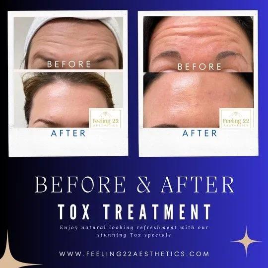 Comparison of forehead skin before and after toxin treatment, showing reduced wrinkles in the after images, with promotional text for Botox treatment at Feeling 22 Aesthetics.