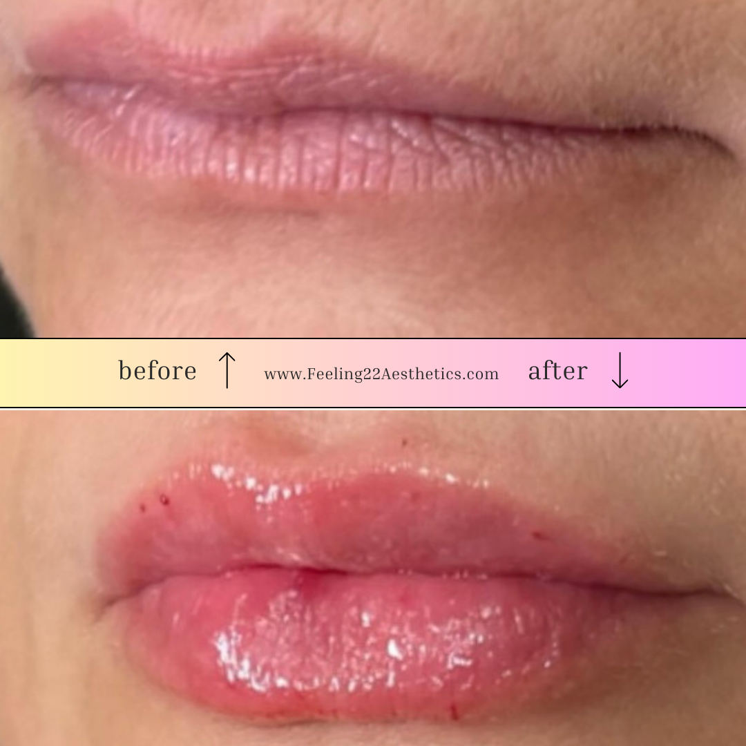 Close-up of lips showing before and after a cosmetic lip treatment, with smoother, glossier lips in the after photo.