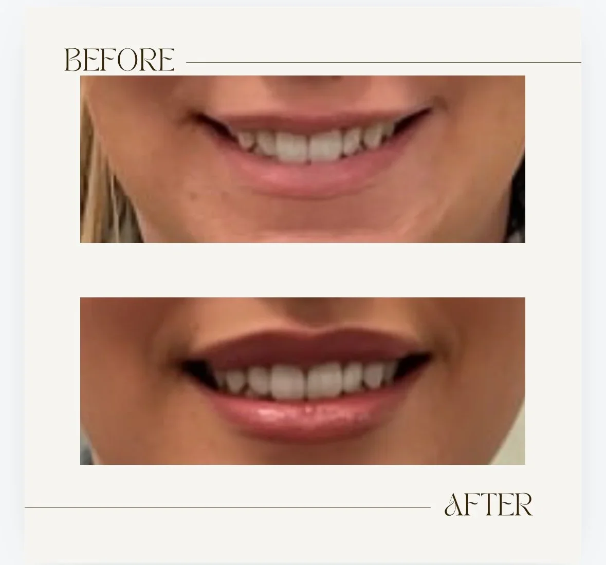Comparison of teeth before and after dental treatment, showing an improved smile with whiter, straighter teeth.