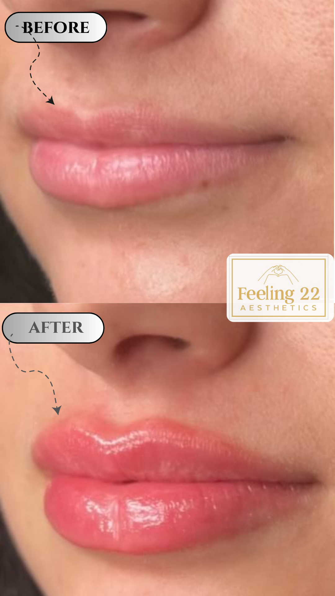 Close-up of lips before and after a lip enhancement procedure. The 'before' image shows natural, unenhanced lips, while the 'after' image displays plumper, glossy, and more defined lips. The images are from Feeling 22 Aesthetics.