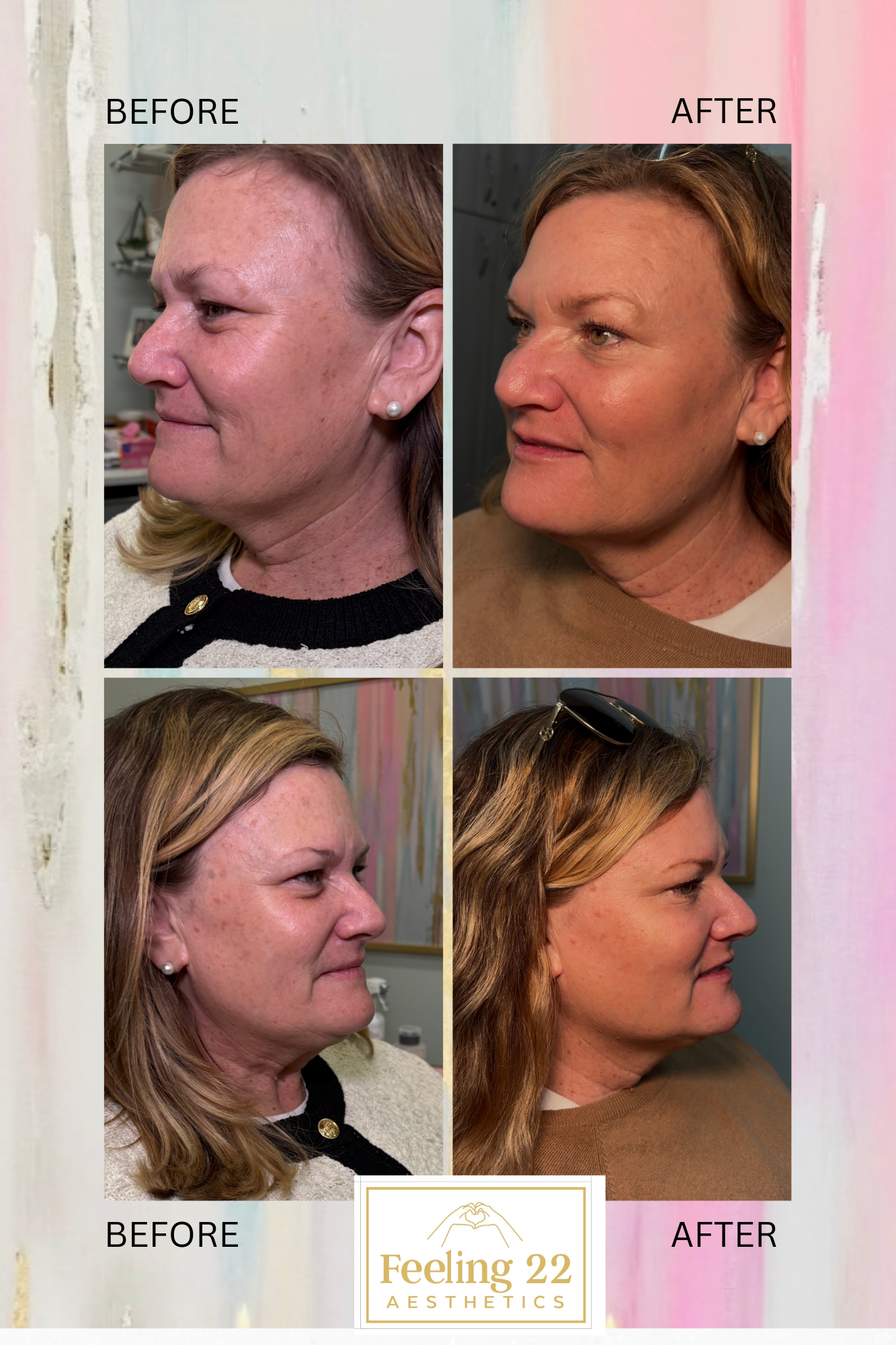 Before and after photos showing a woman's facial skin improvement, with the before images on the left and the after images on the right, under a logo for Feeling 22 Aesthetics.