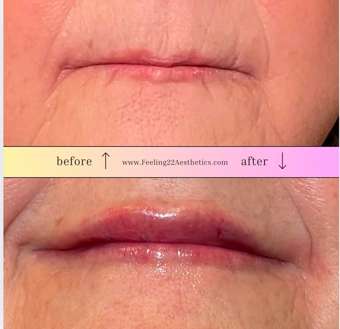 Close-up of lips before and after a cosmetic treatment, showing improved lip appearance and reduced fine lines after the procedure.