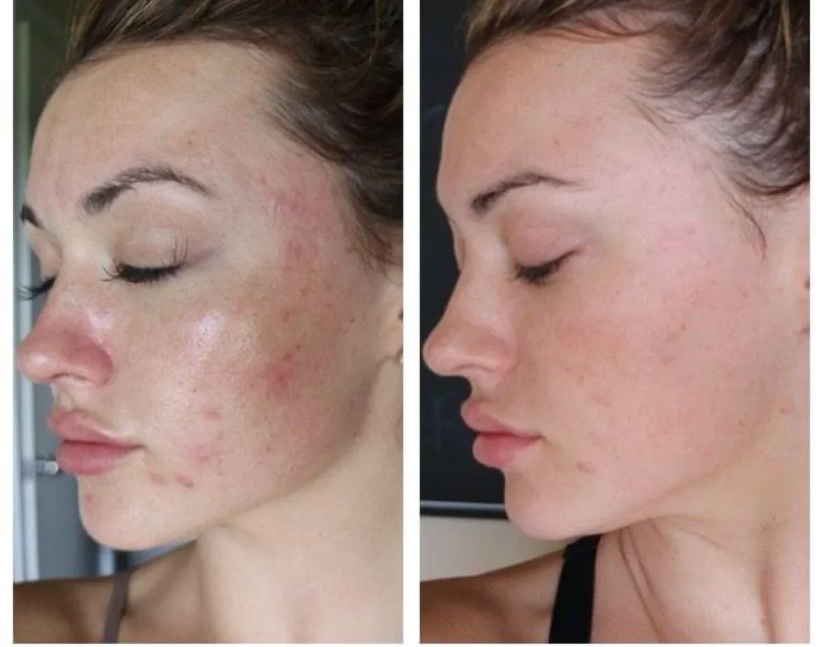 Before and after comparison of a woman's face showing improvement in skin clarity, texture, and reduction of acne scars.