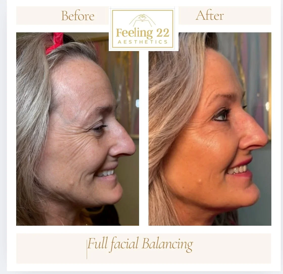 Side-by-side before and after photos of a woman showing facial improvements after aesthetic treatment, with the caption 'Full facial Balancing' and the logo 'Feeling 22 Aesthetics' at the top.