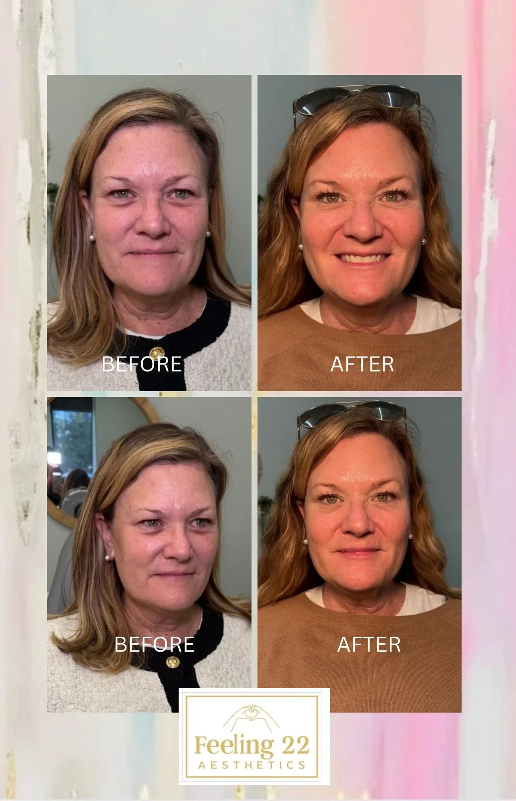Side-by-side before and after photos of a woman showing facial skin improvements, with the logo 'Feeling 22 Aesthetics' at the bottom.