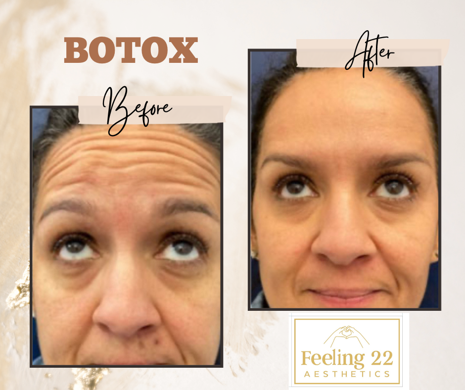 Side-by-side comparison of a woman's face before and after Botox treatment, showing reduced forehead wrinkles and smoother skin.