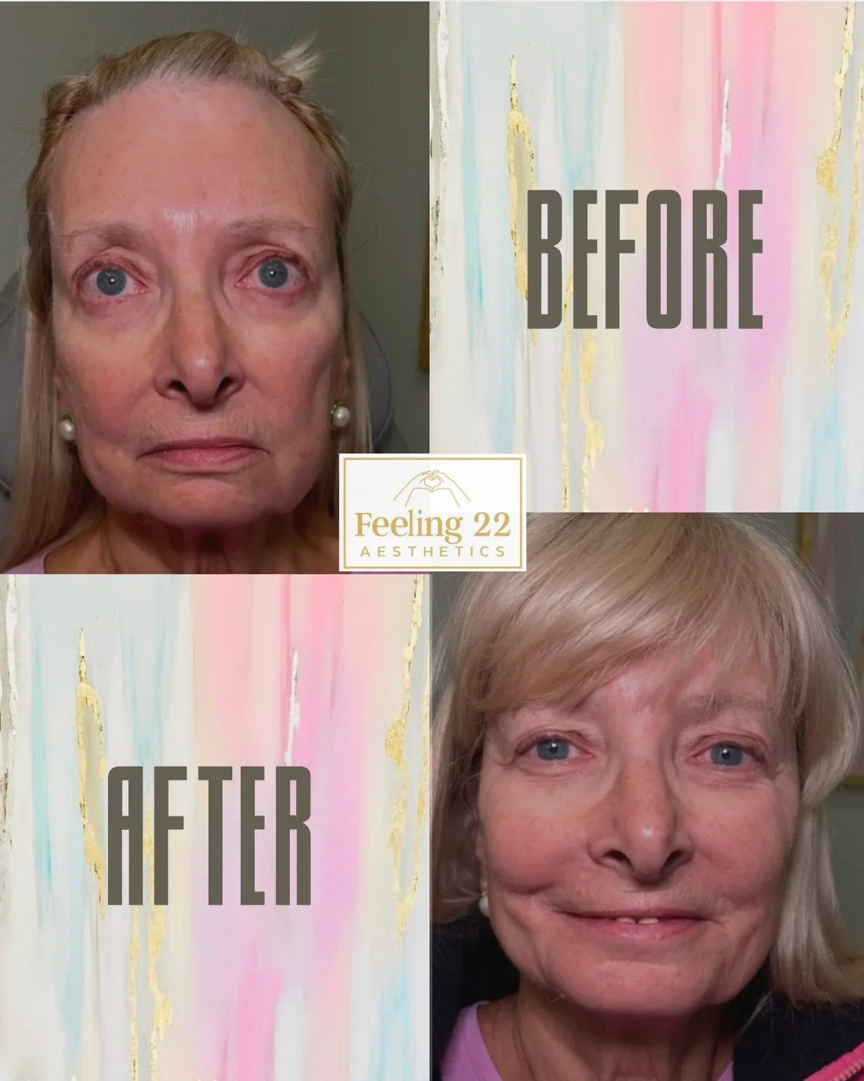 Comparison of a woman's face before and after aesthetic treatment, with a background image labeled 'BEFORE' and 'AFTER', and a logo for Feeling 22 Aesthetics.