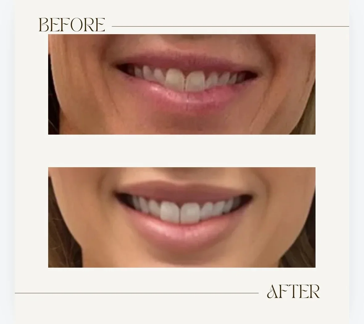 Comparison of teeth before and after dental work, showing improved teeth alignment and appearance.