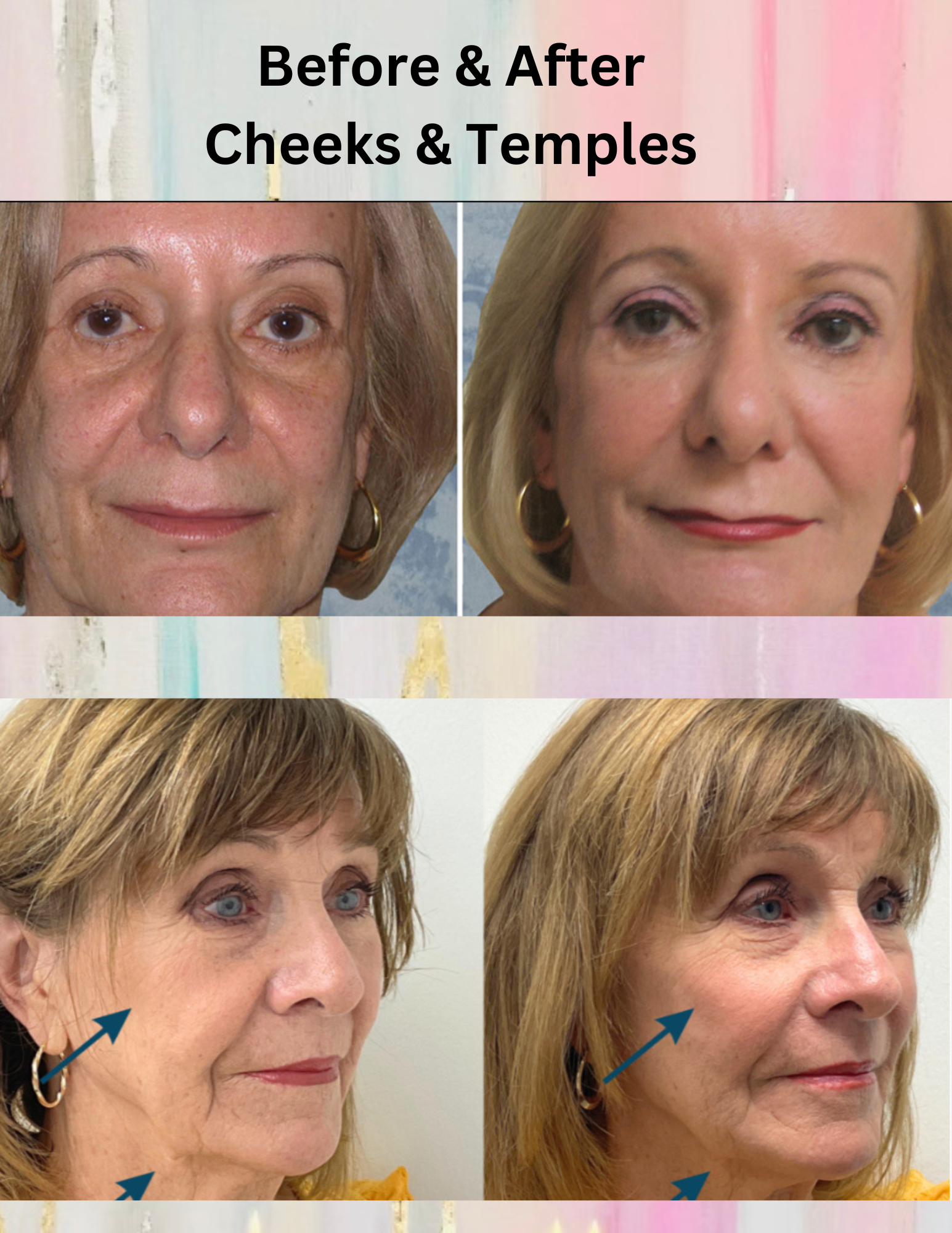 Before and after comparison of a woman's face showing the effects of Cheek and Temple fillers. The top row shows her face before and after treatment, with smoother skin and fuller cheeks. The bottom row highlights her profile before and after treatme