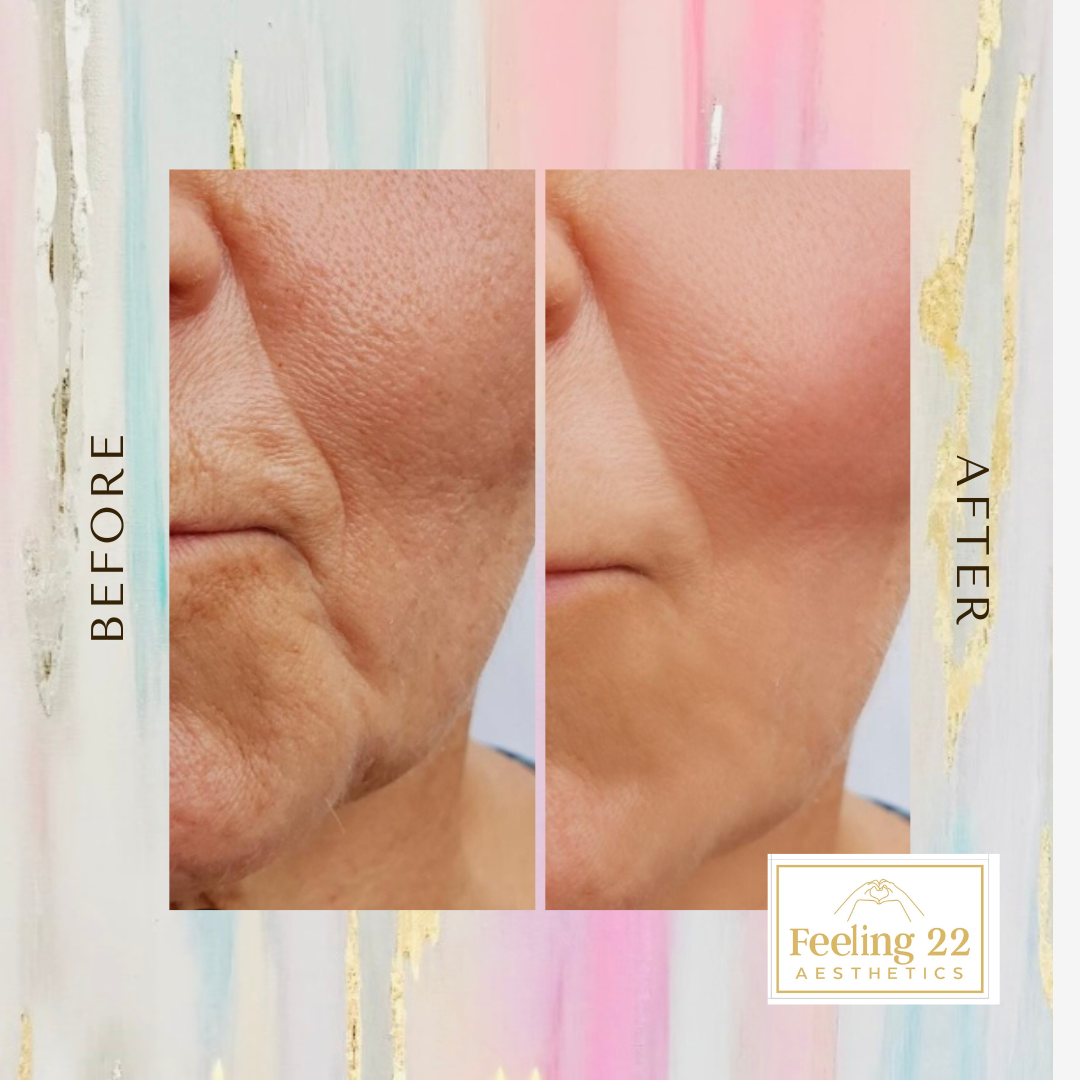 Before and after close-up images of facial skin showing improved texture and reduced wrinkles, with the branding of Feeling 22 Aesthetics.