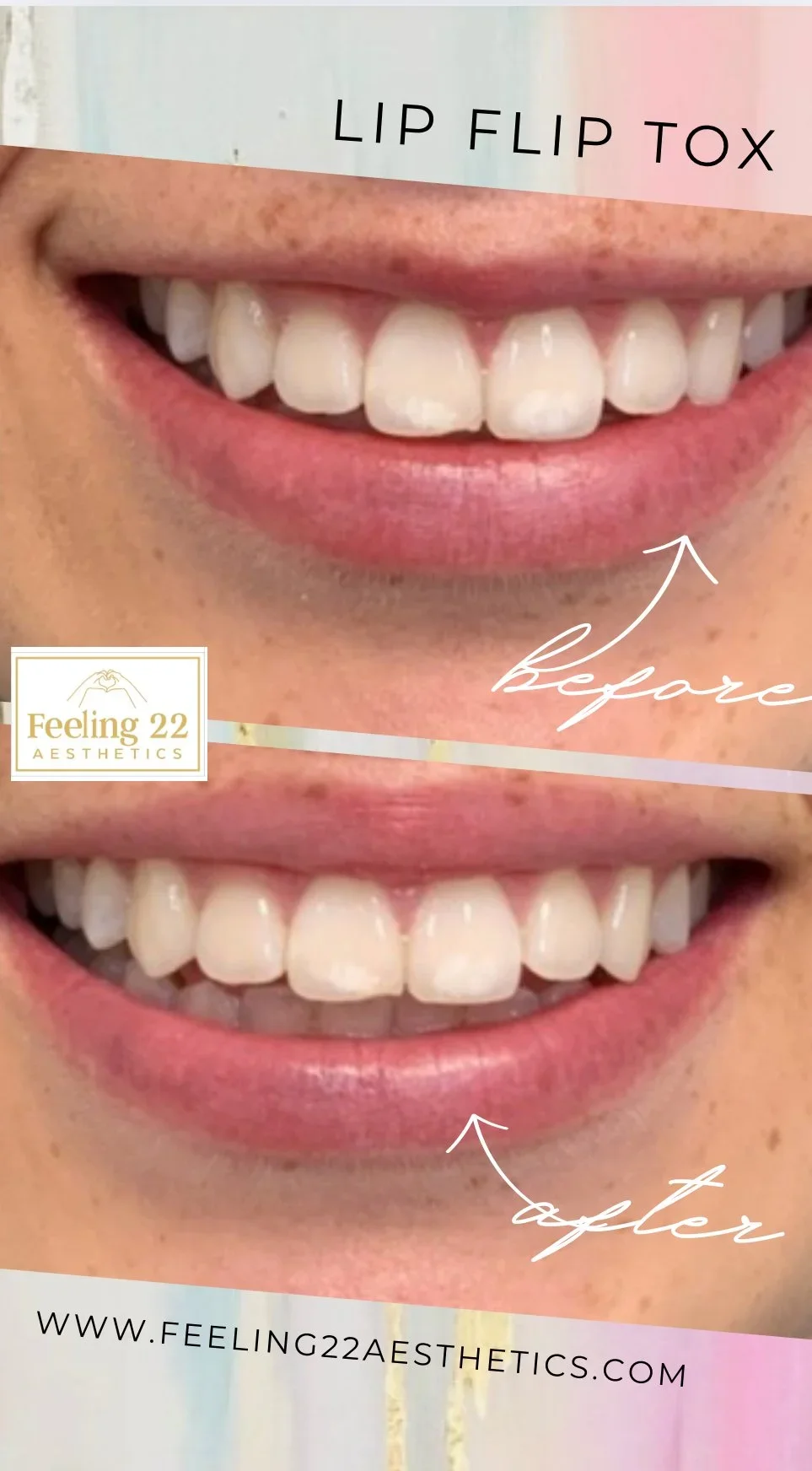Comparison of a person's teeth before and after dental treatment, showing improved teeth alignment and appearance.