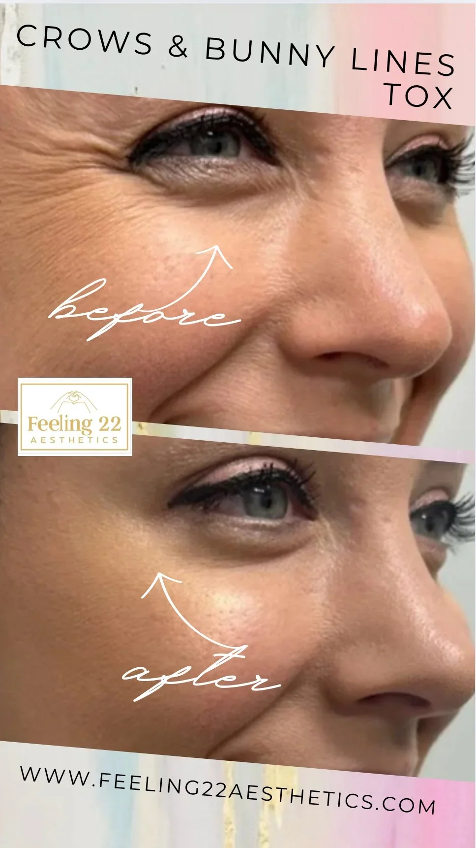 Close-up of a woman's face showing the area around her eyes, with markings indicating before and after cosmetic treatment for crow's feet and bunny lines. The top part labeled 'before' and the bottom part labeled 'after'.