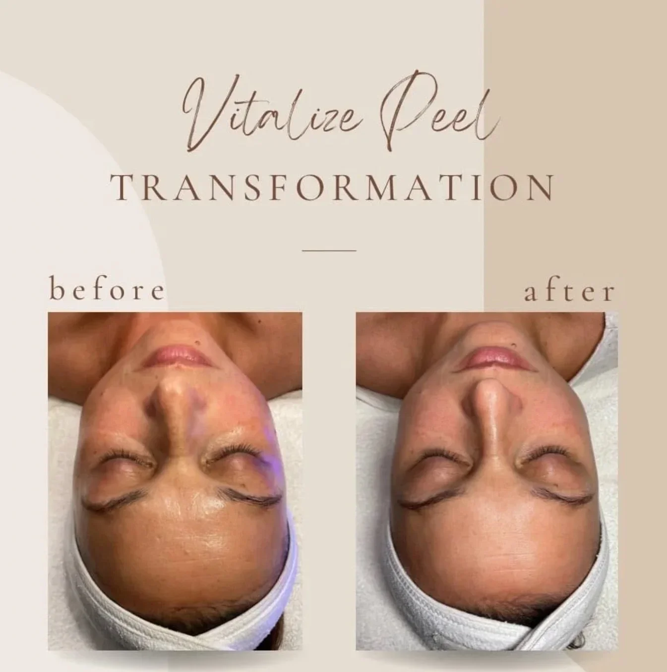 Side-by-side comparison of a woman's face before and after facial peel treatment, showing smoother skin and reduced blemishes.