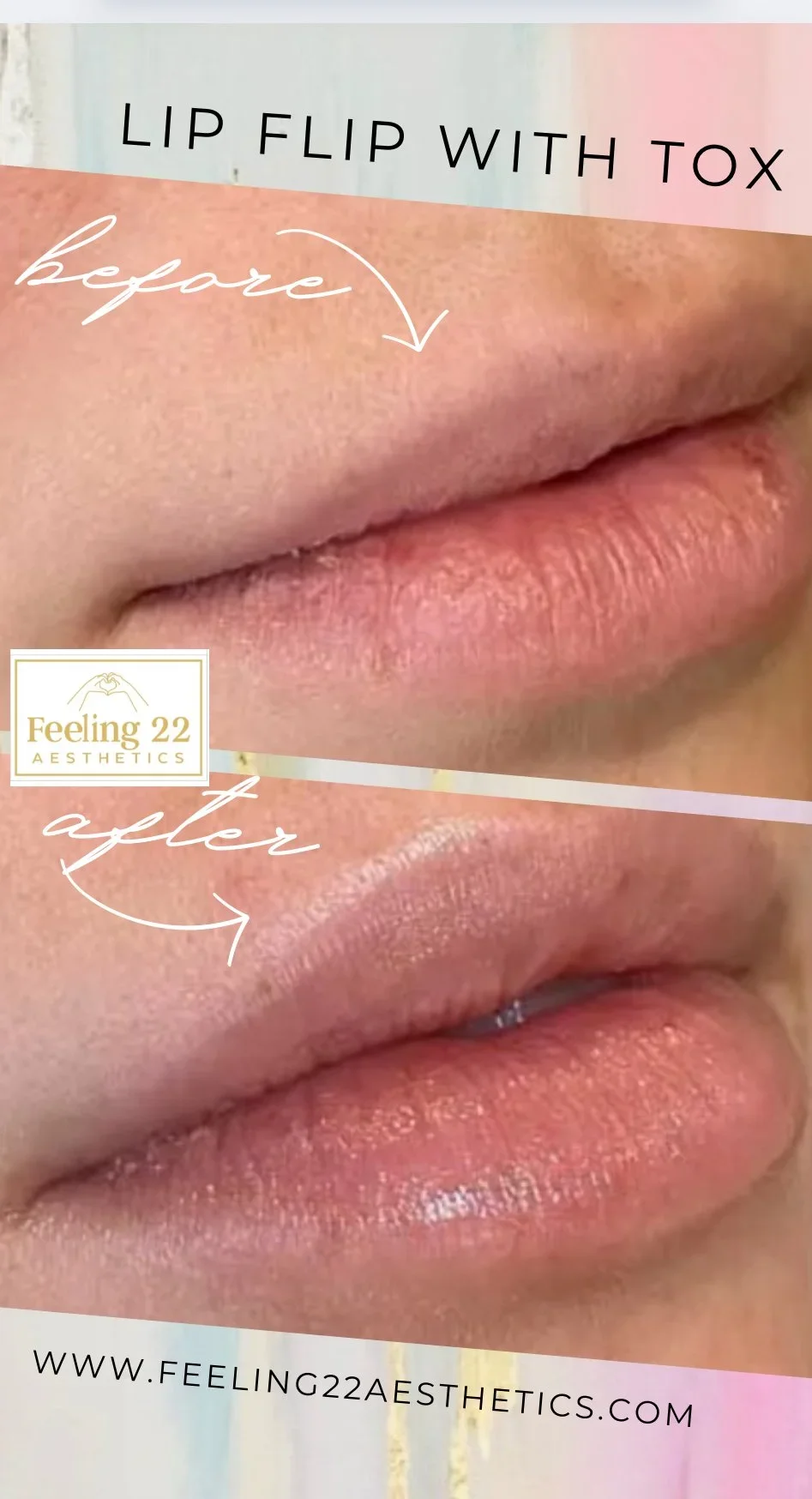 Before and after images of lips showing the effects of lip flip treatment with Botox, labeled 'LIP FLIP WITH TOX' and 'before' and 'after' captions.