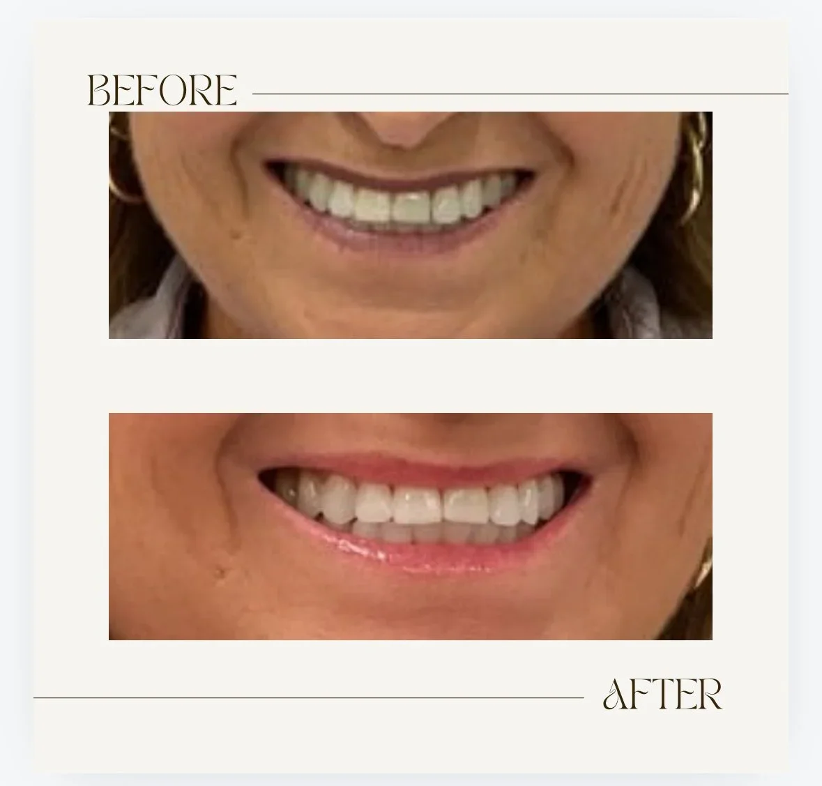 Comparison of a smiling woman's teeth before and after dental treatment, showing improved teeth alignment and whiteness.