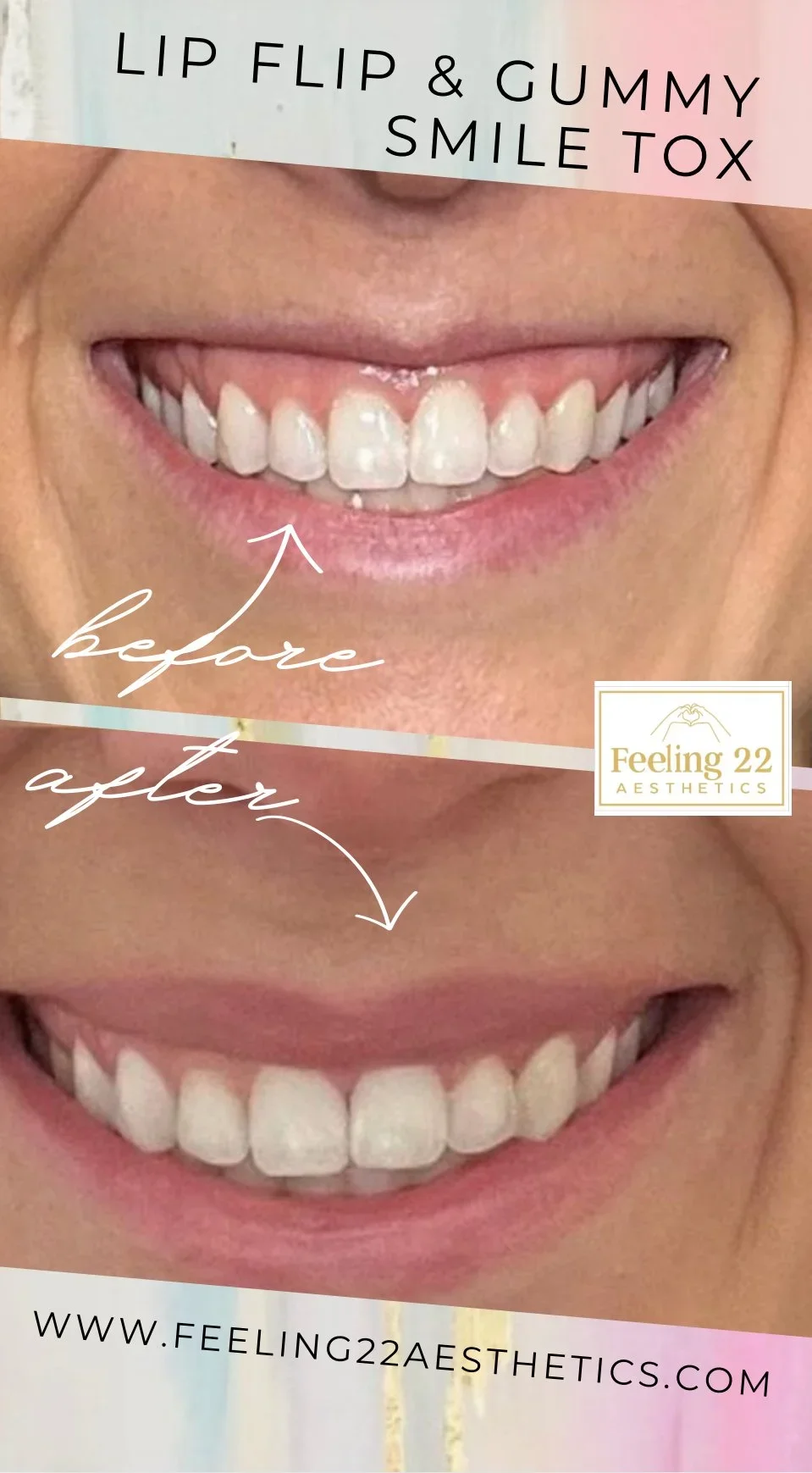Comparison of a person's smile before and after a gummy smile reduction treatment. The top image shows a gummy smile with excess gums visible, and the bottom image shows a more proportionate, improved smile after treatment. Text on the image includes