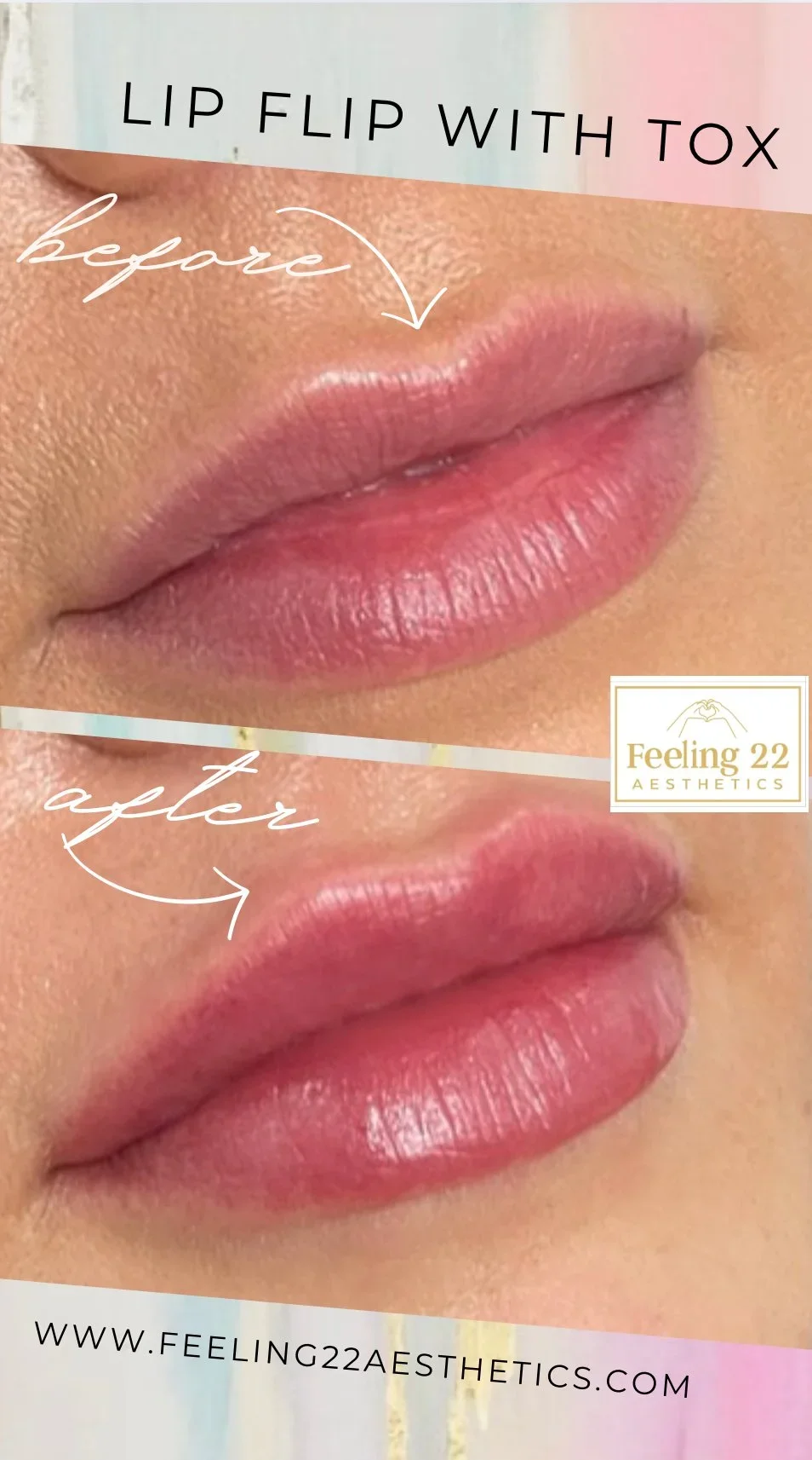 Before and after images of lips showing lip augmentation with a caption 'LIP FLIP WITH TOX' and the brand Feeling 22 Aesthetics logo.