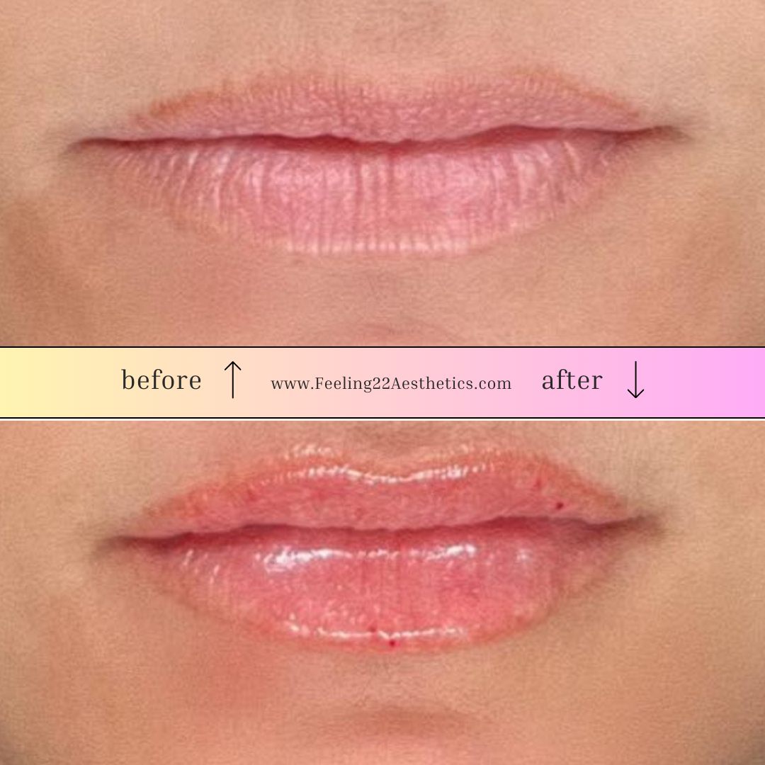 Comparison of lips before and after aesthetic treatment, showing smoother and shinier lips post-treatment.