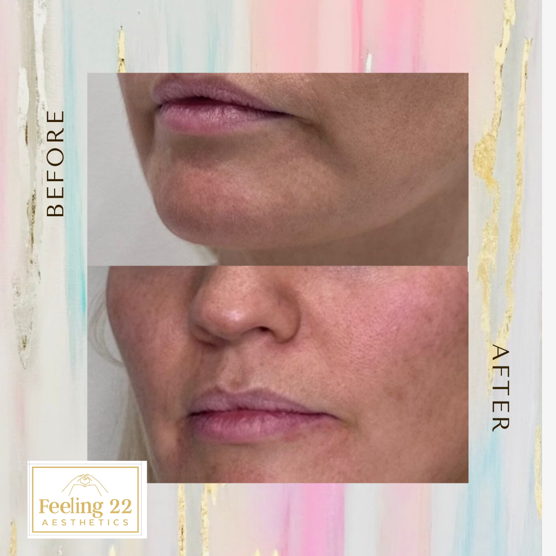 Side-by-side comparison of a person's lower face showing improved skin texture and fewer wrinkles after aesthetic treatment from Feeling 22 Aesthetics.