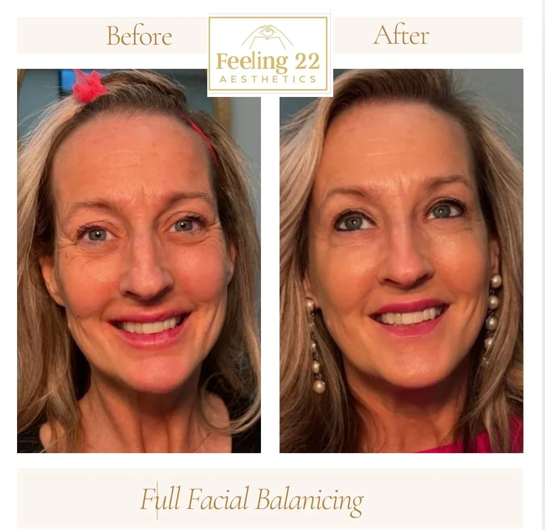 Side-by-side comparison of a woman's face before and after facial balancing treatment, showing improvements in facial symmetry and appearance, with the before photo on the left and the after photo on the right.