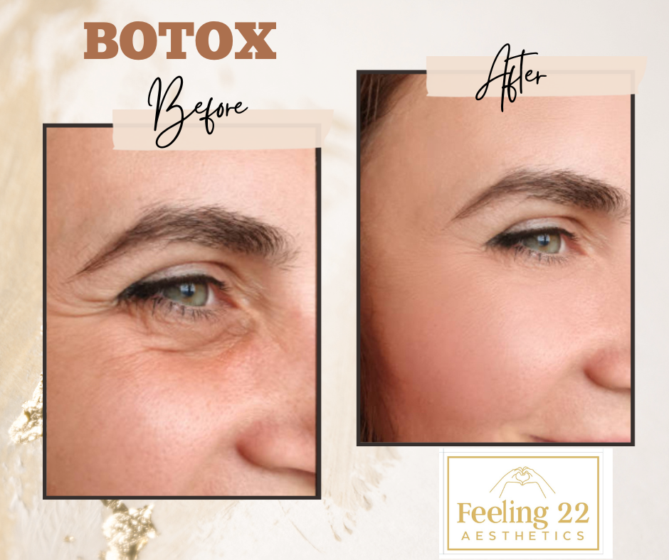 Side-by-side comparison of a woman's eye area before and after Botox treatment showing reduced wrinkles and smoother skin.