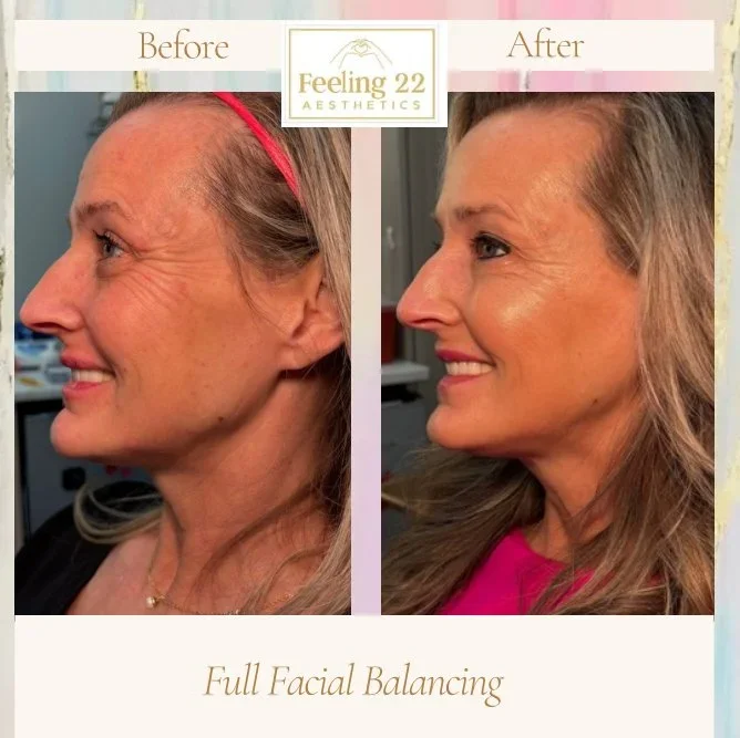 Side-by-side before and after photos of a woman's face showing facial improvements after full facial balancing treatment by Feeling 22 Aesthetics.