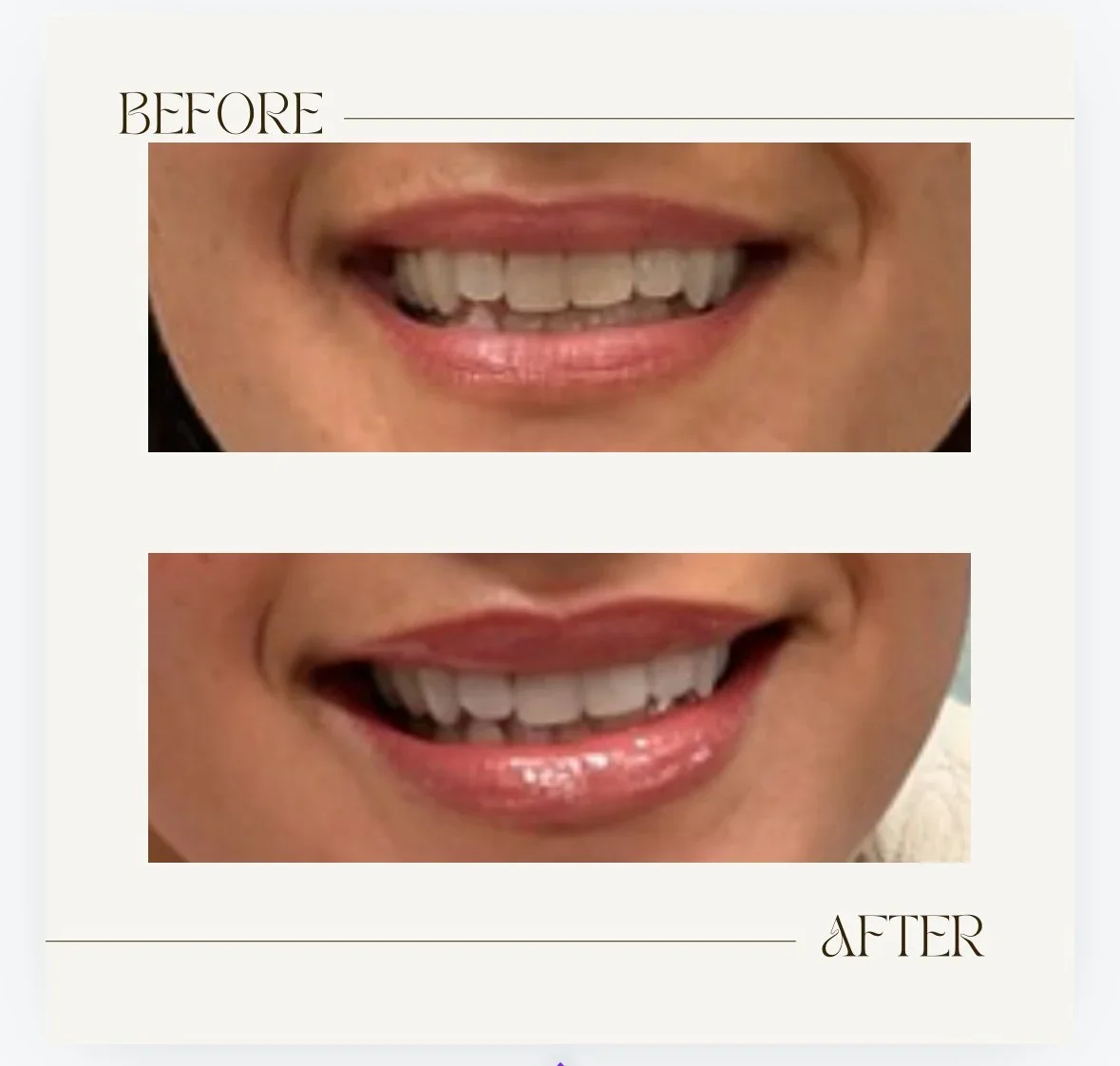 Comparison of teeth and smile before and after dental treatment, with the top showing stained and crooked teeth and the bottom showing whiter, straighter teeth.