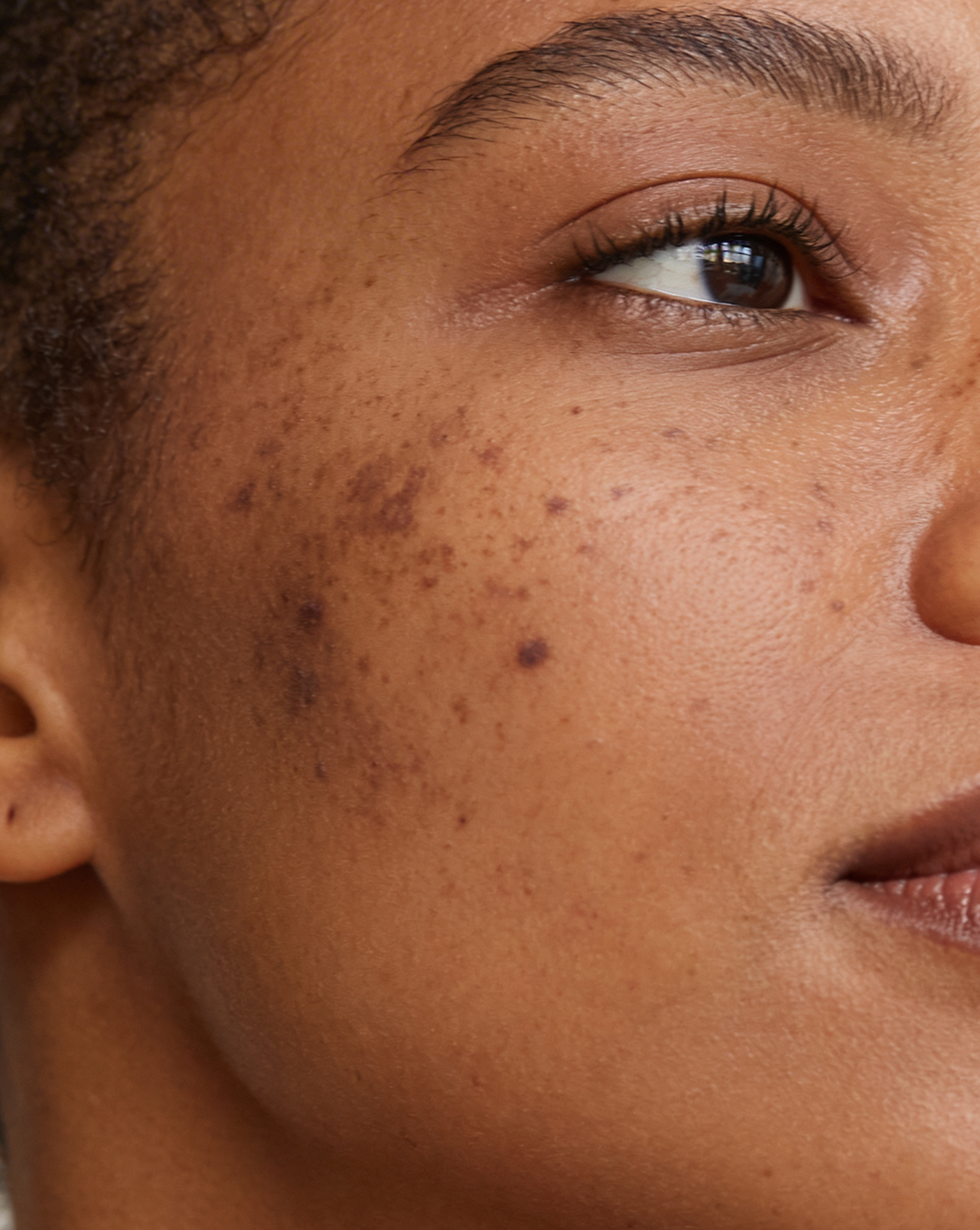 Hyperpigmentation, Acne Scarring &amp; Combination Skin — What's the Difference &amp; How to Treat Each