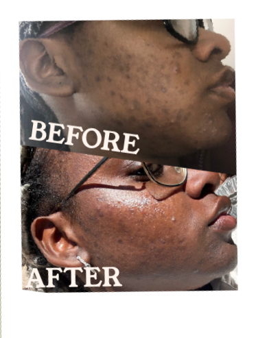 Side-by-side comparison of a person's face showing significant acne scarring reduction and clearer skin in the after photo, with the before photo showing prominent acne scars.