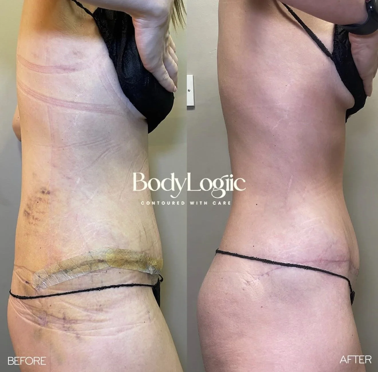 Tummy tuck, liposuction & muscle repair