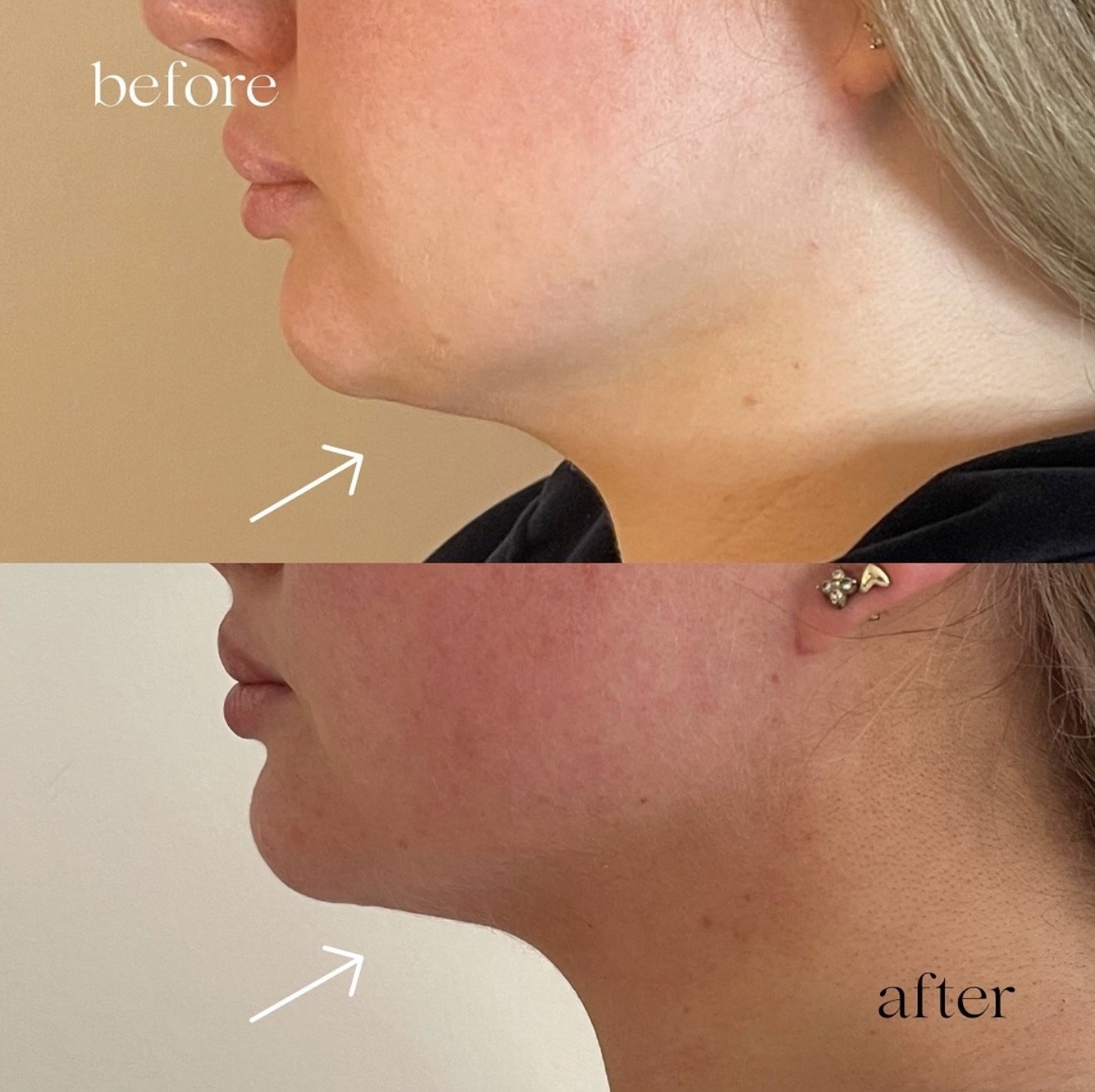 Post chin liposuction