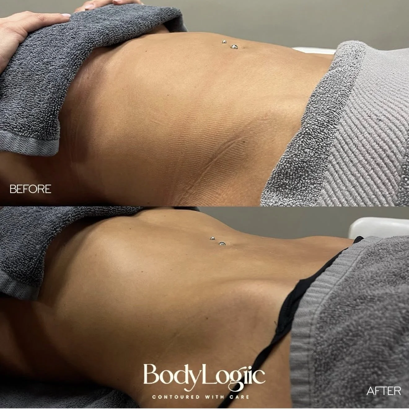 Comparison of a person's abdominal area NON SURGICAL before and after a debloat & drain treatment, showing a smoother and more toned appearance after treatment.