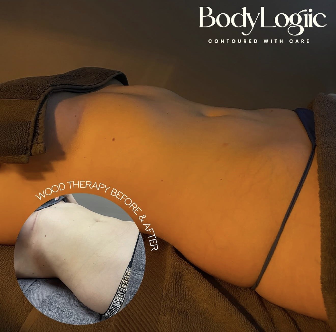 Before & After of non surgical wood therapy treatment. 