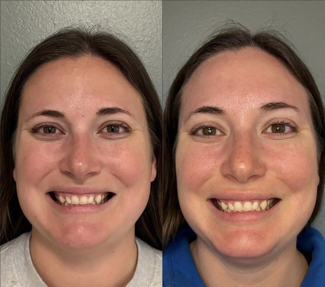 A Natural, Balanced Full-Face Refresh at Wave Aesthetics