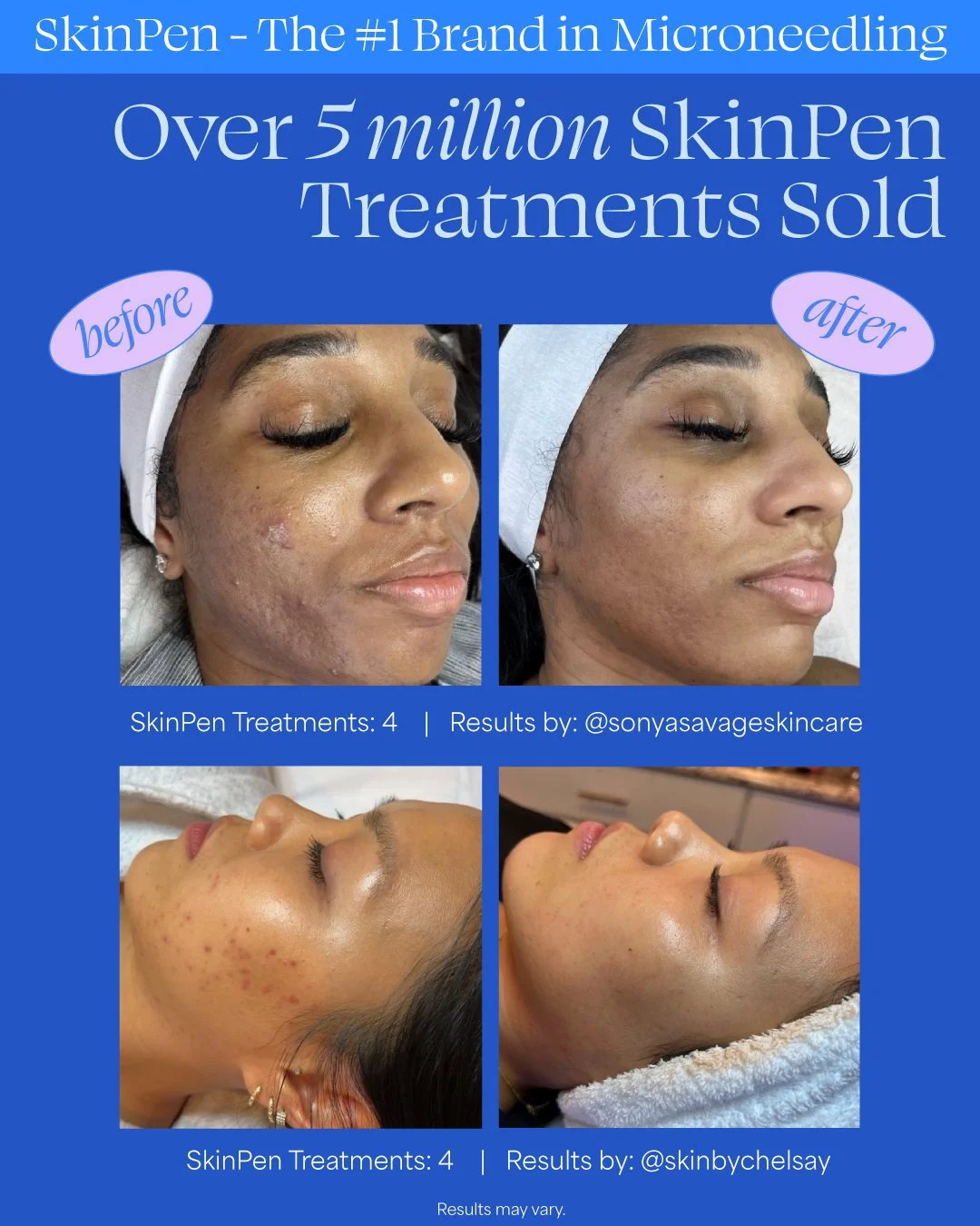 Microneedling-Texture-Improvement-Before-After