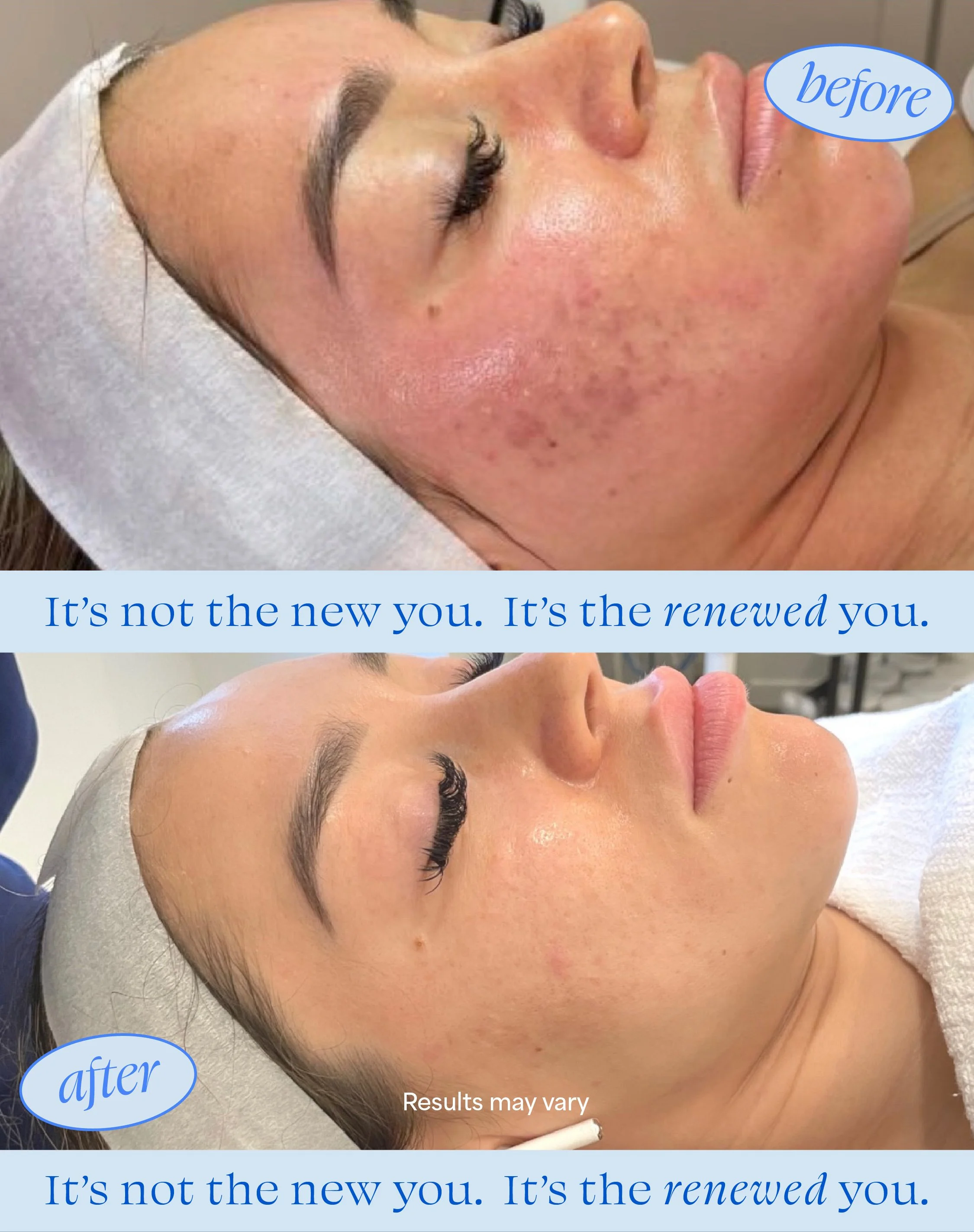 SkinPen Microneedling: The Most Natural Way to Renew Your Skin