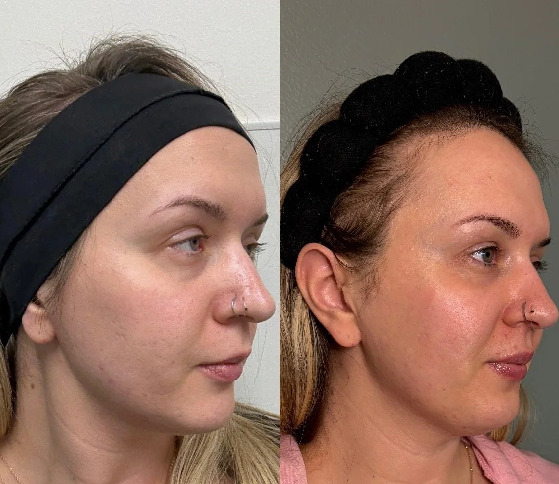 Natural looking cheek filler