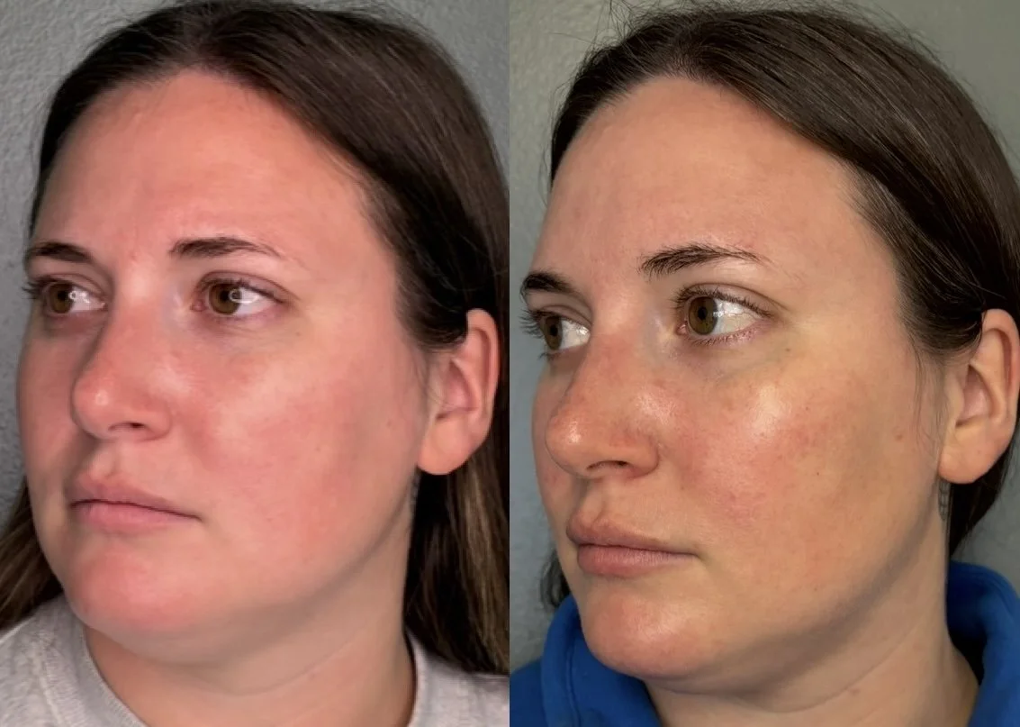 Restorative cheek filler