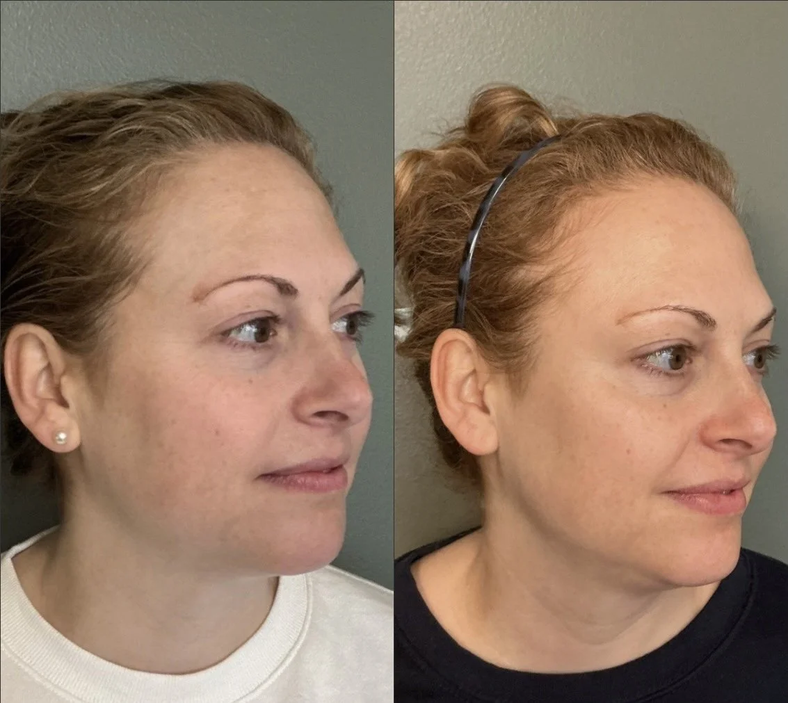 cheek filler 