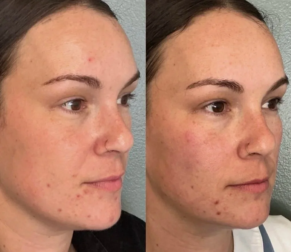 Cheek filler Ann Arbor