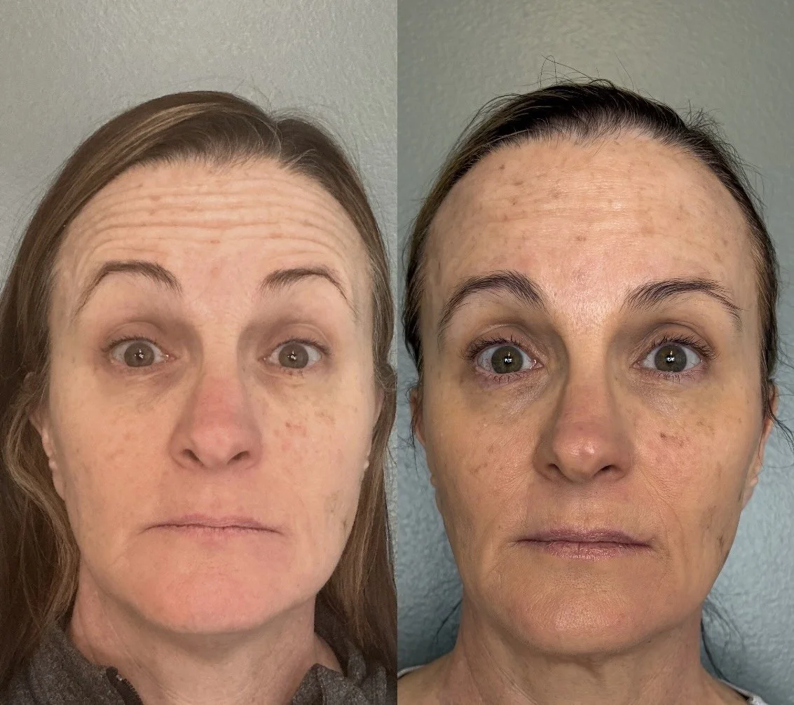 botox-ann-arbor-forehead-lines.jpg