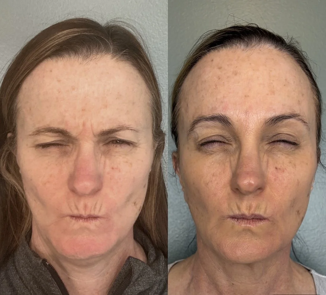 botox-ann-arbor-frown-lines.jpg