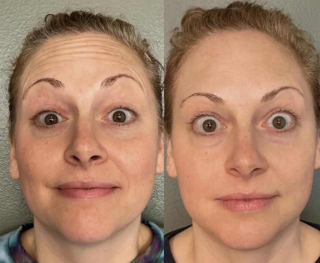 Dysport Day at Wave Aesthetics: Everything You Need to Know