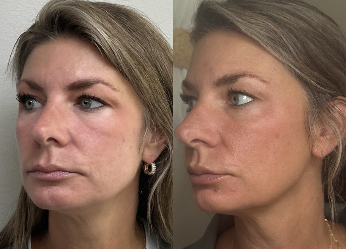 Full Facial Balancing in Ann Arbor: A Personalized Approach to Natural Results
