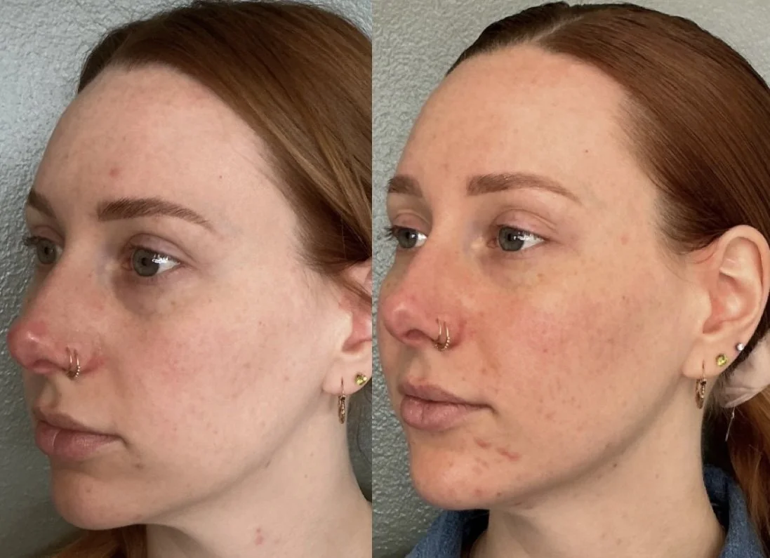Full facial balancing- full face dysport, lip dissolve, cheek filler, chin filler