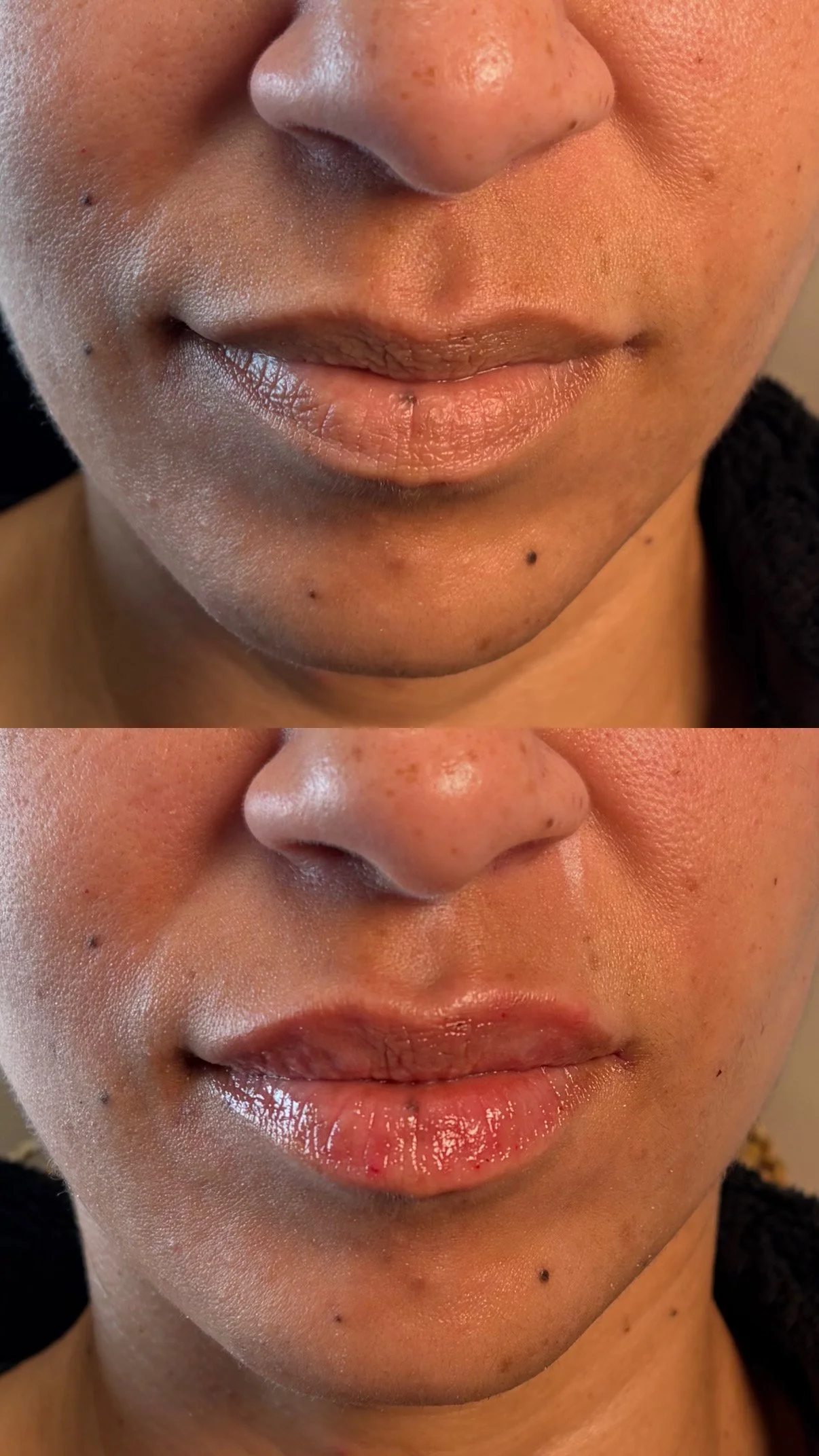 Lip filler (half syringe)
