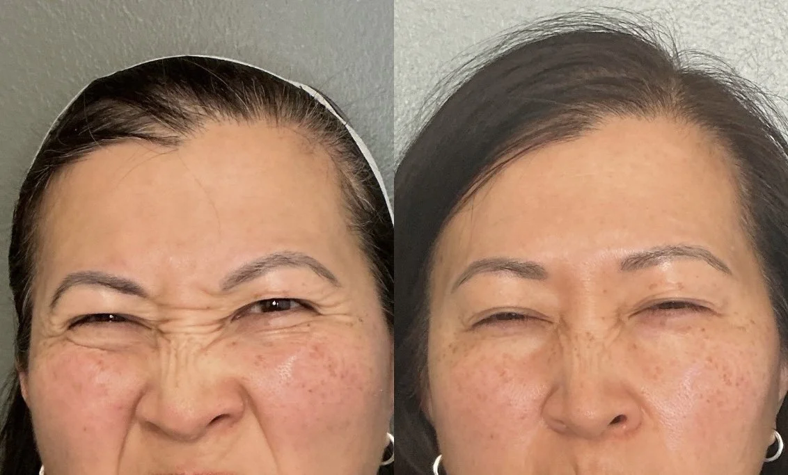 Botox frown lines