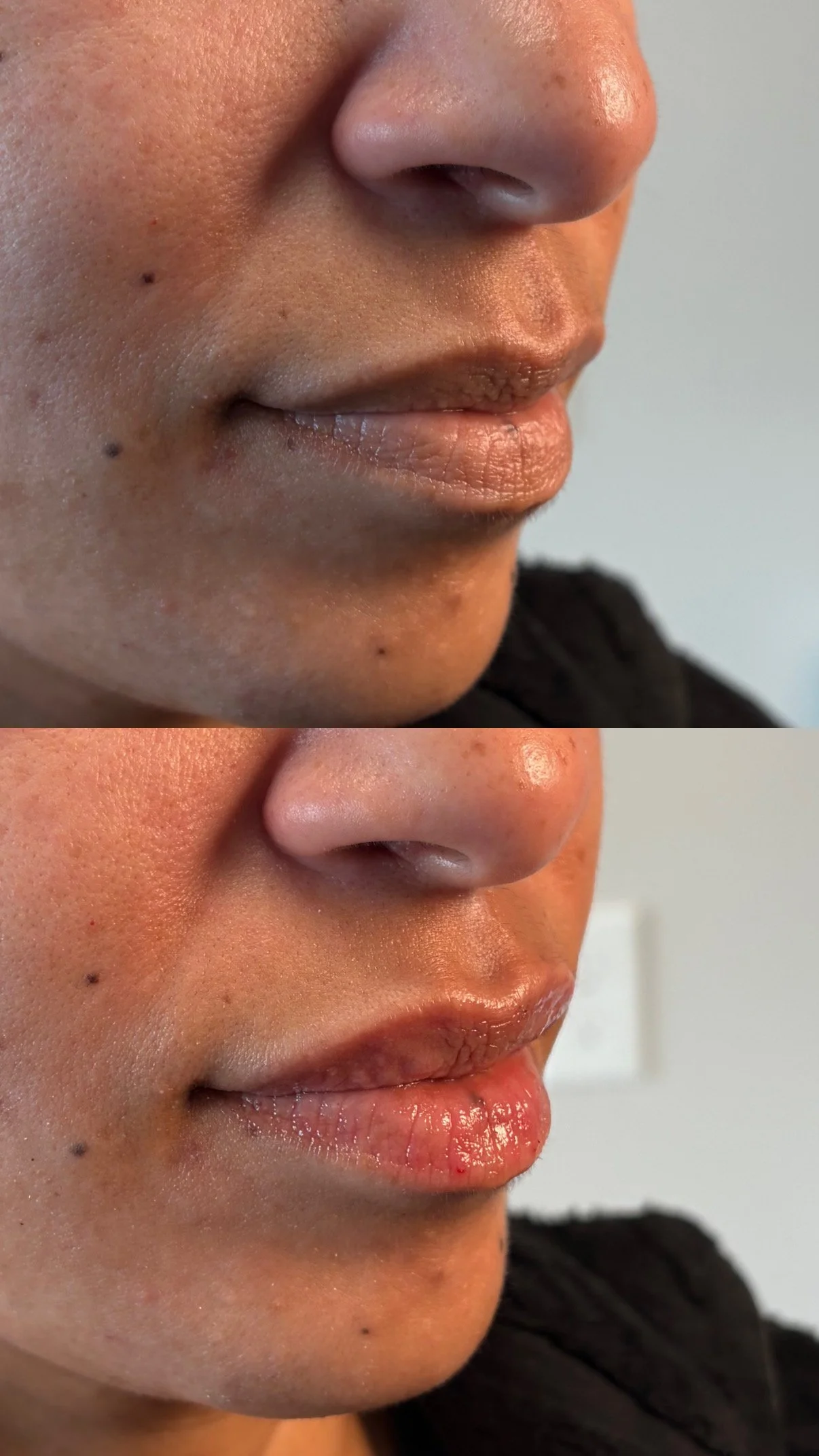 Lip filler (half syringe)